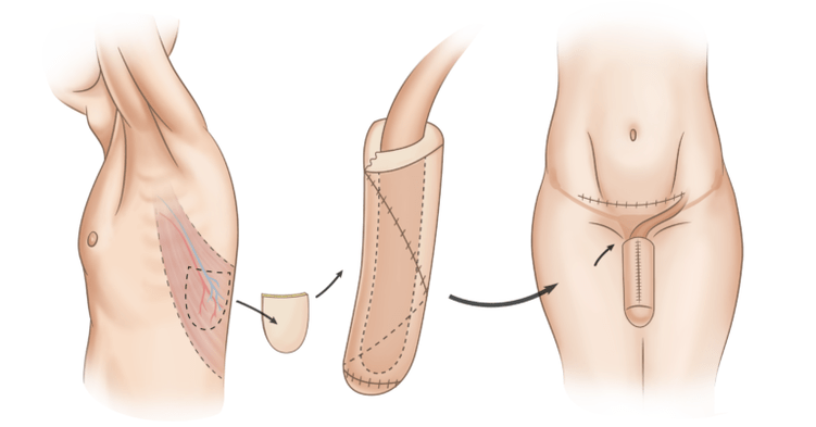 falloplasty for penis enlargement